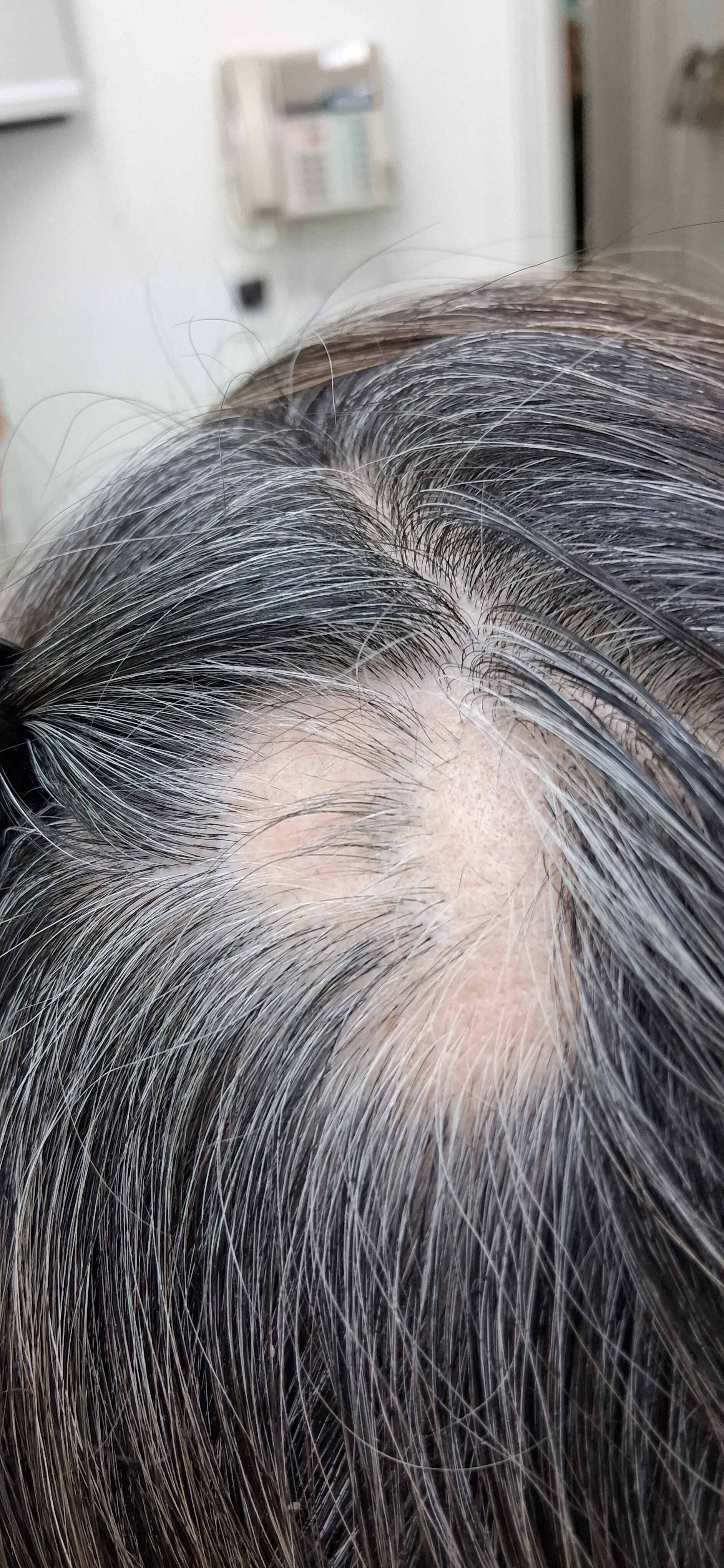 Alopecia areata: imagen antes