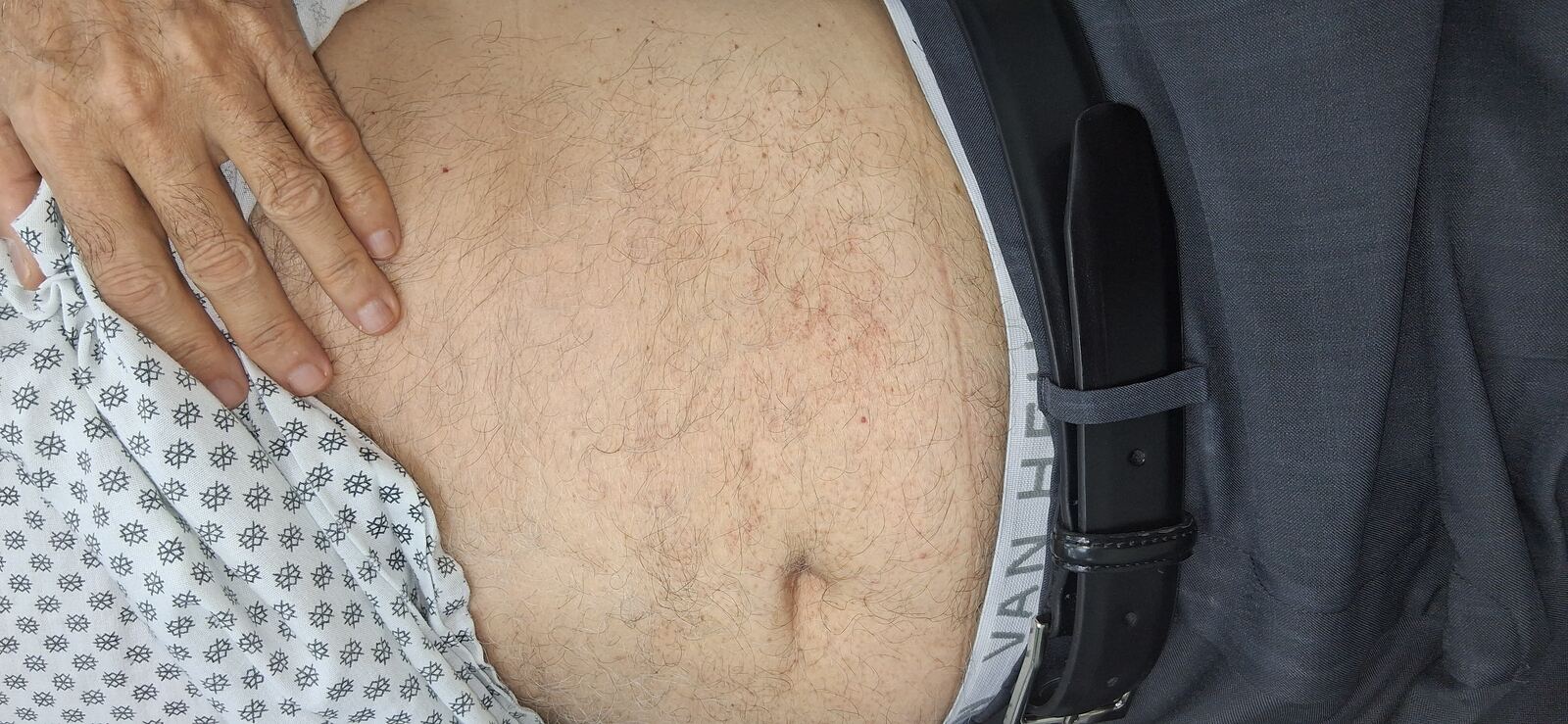 Capilaritis abdominal y xerosis: imagen después