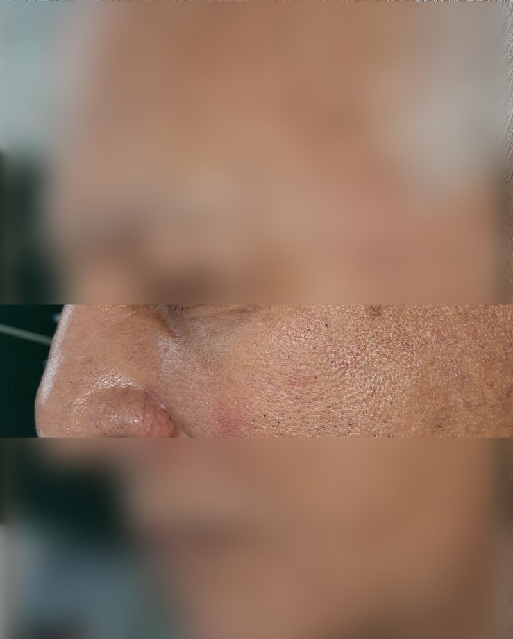 Demodex y dermatitis seborreica: imagen después