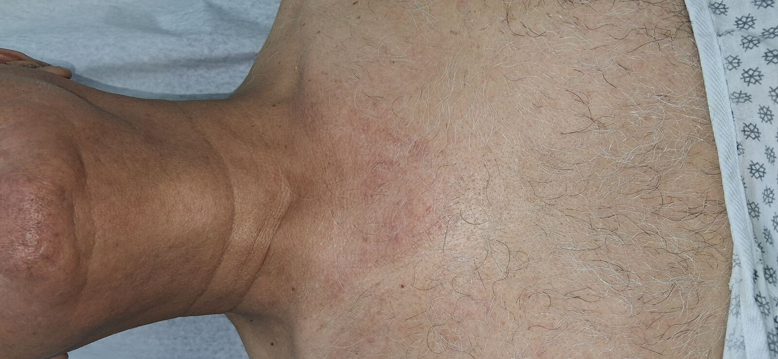 Caso clínico de Demodex y dermatitis seborreica