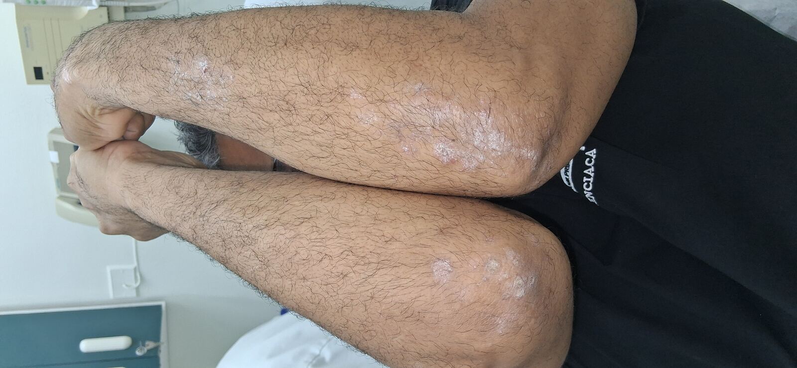 Dermatitis liquenoide vs psoriasis: imagen antes