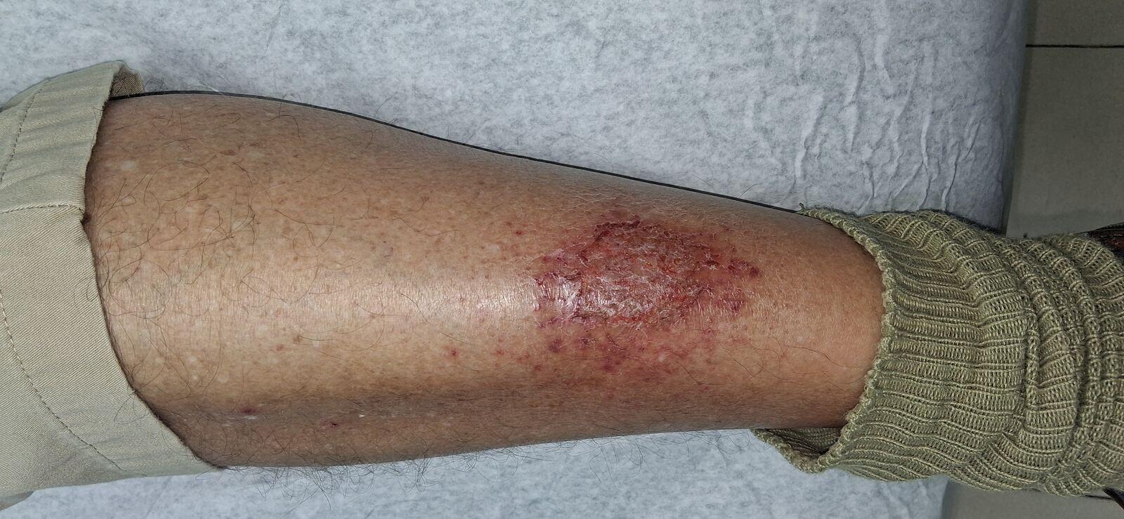 Eczema de estasis y dermatitis craquelé: imagen antes