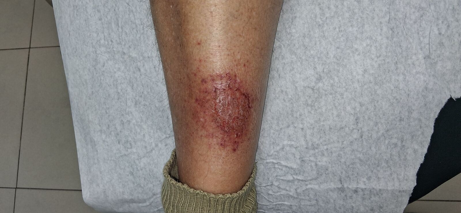 Eczema de estasis y dermatitis craquelé: imagen después