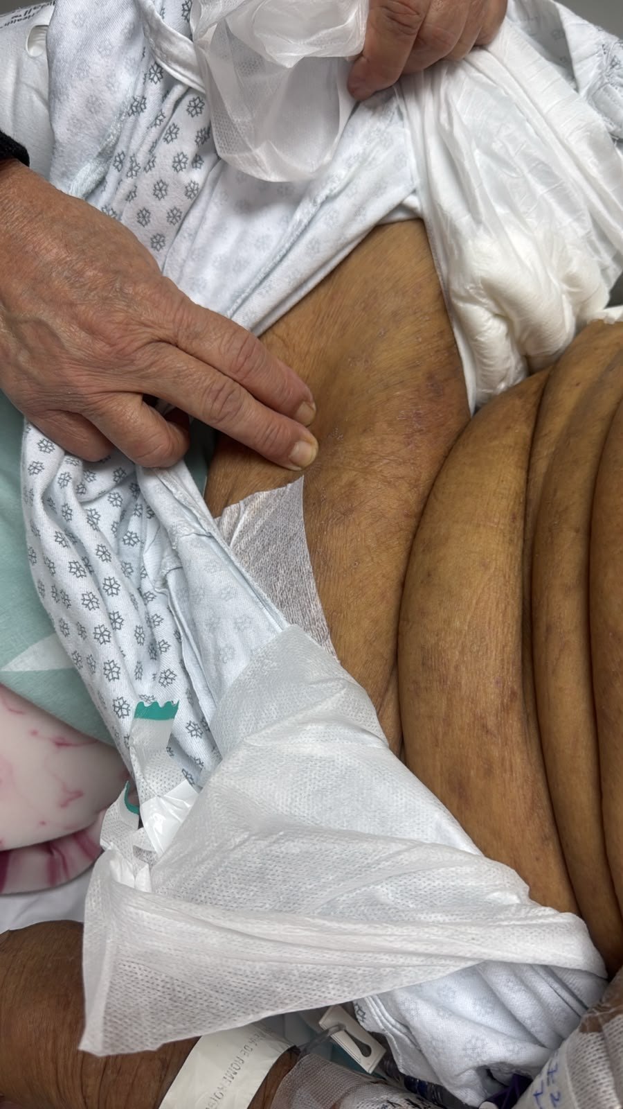 Escabiasis (Sarna): imagen después