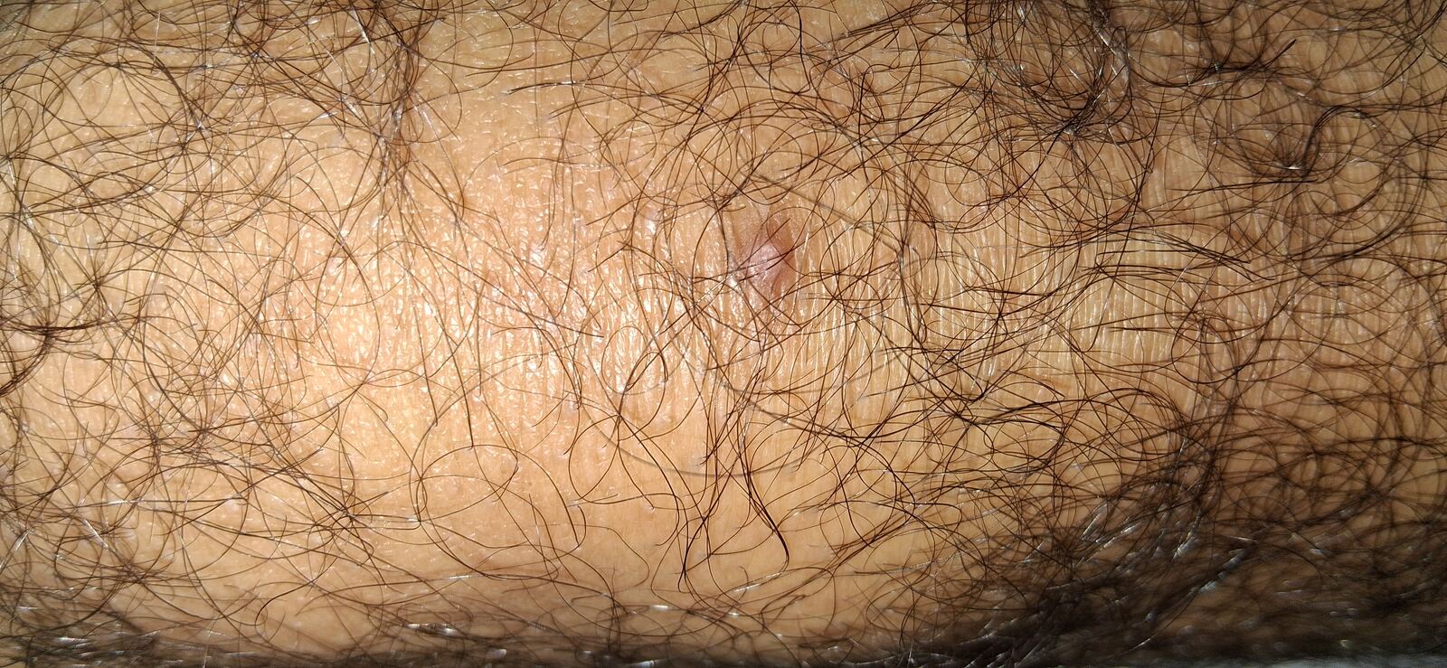 Fibroqueratoma vs verruga: imagen después