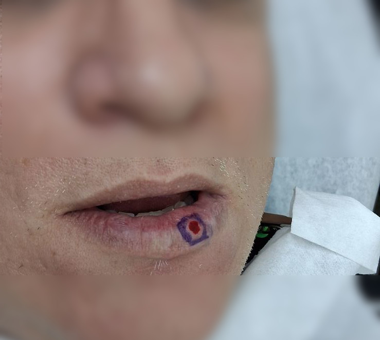 Caso clínico de Lago venoso vs nevus