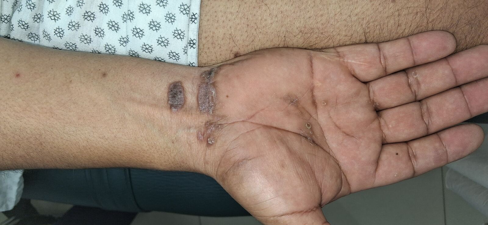 Liquen plano: imagen antes