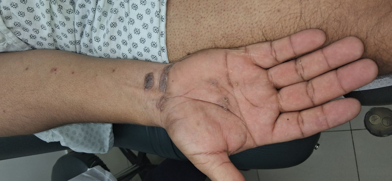 Caso clínico de Liquen plano