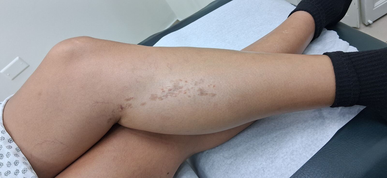 Liquen simplex crónico: imagen después