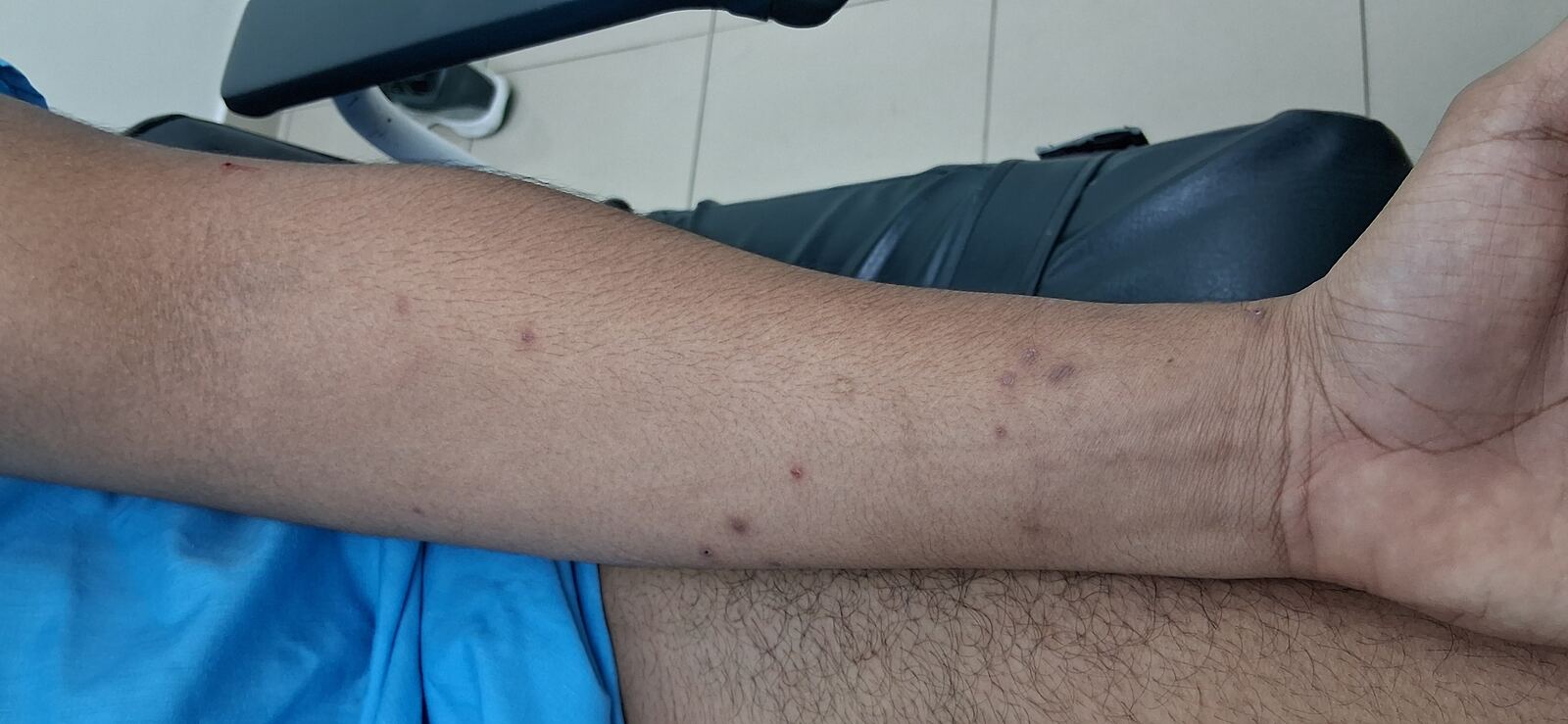 Molusco contagioso: imagen antes