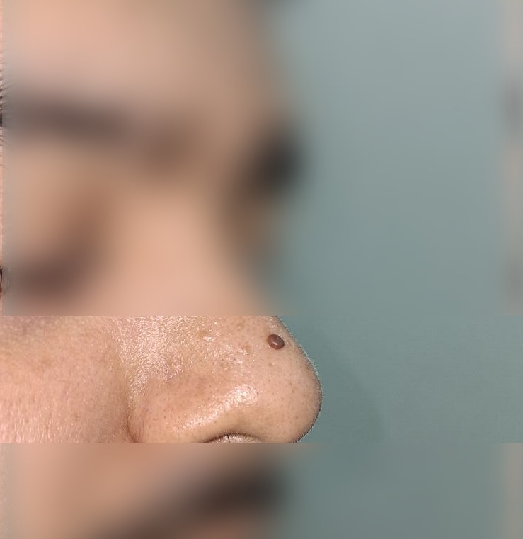 Nevus pedunculado: imagen después