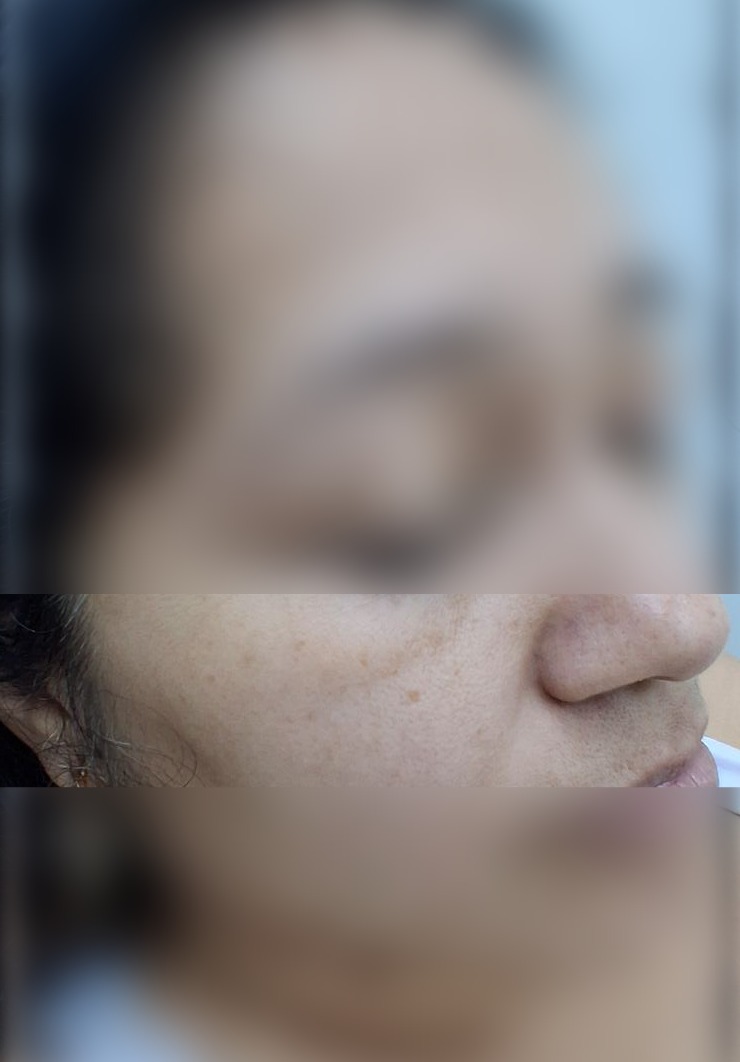Nevus vs carcinoma basocelular: imagen después