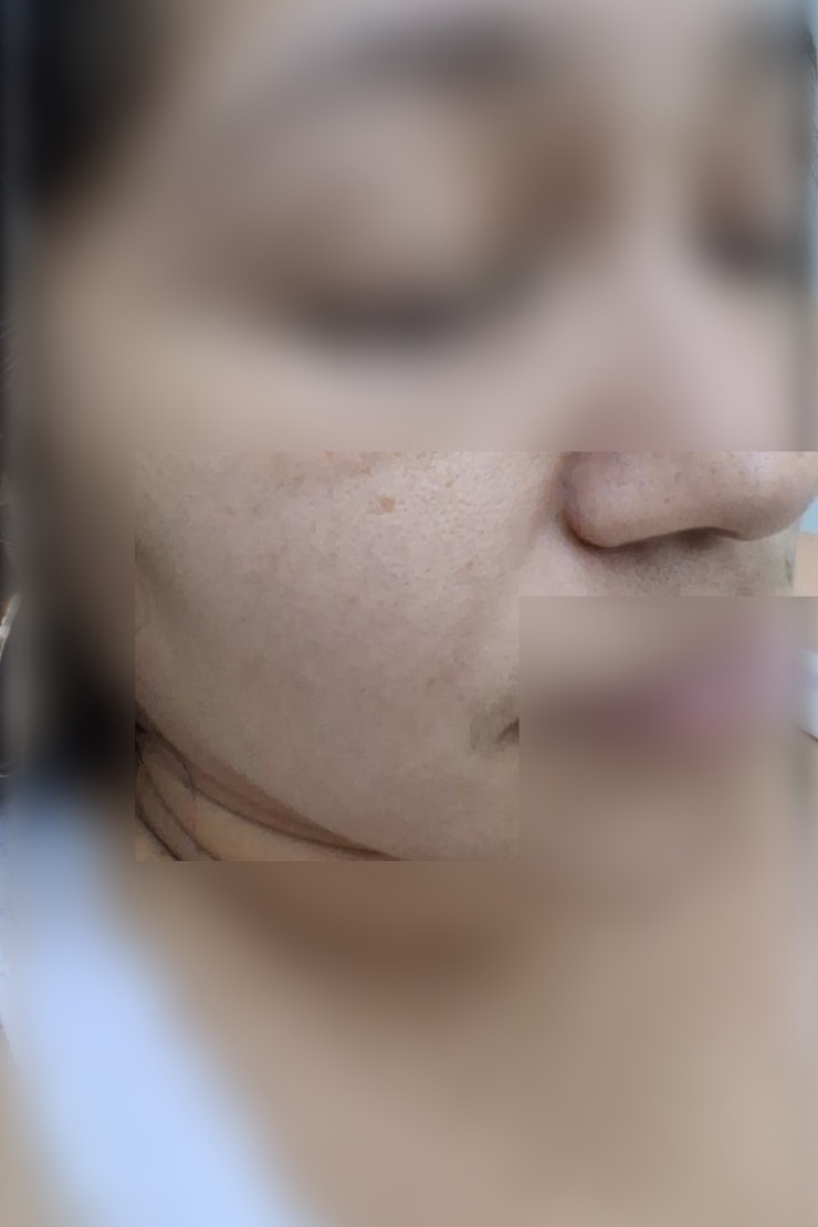 Caso clínico de Nevus vs carcinoma basocelular