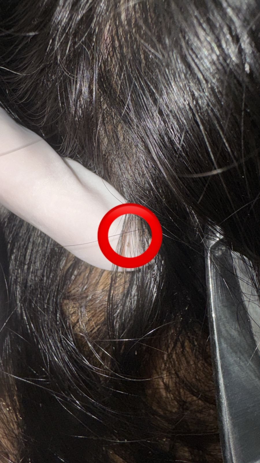 Pediculosis: imagen antes