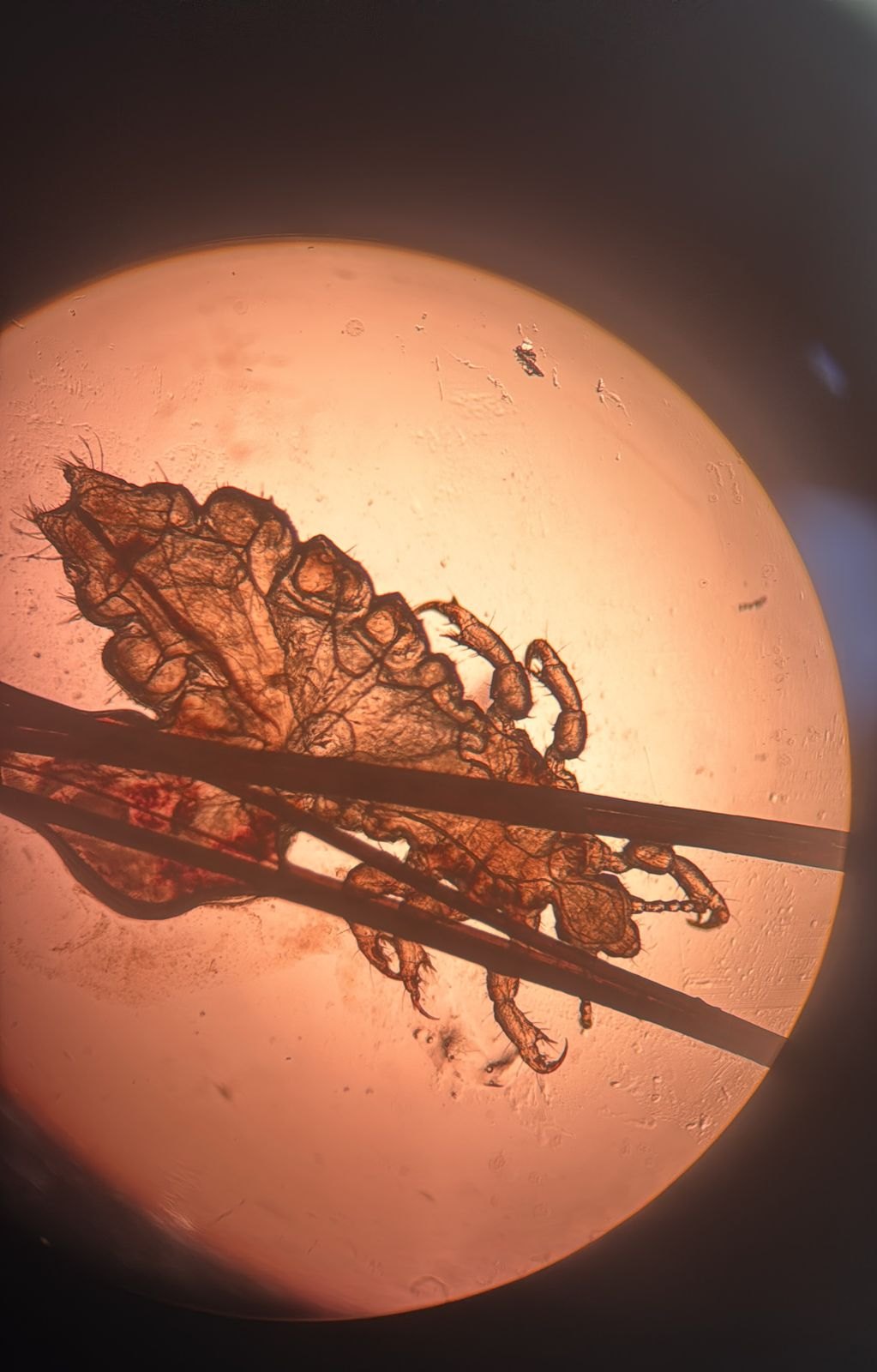 Caso clínico de Pediculosis