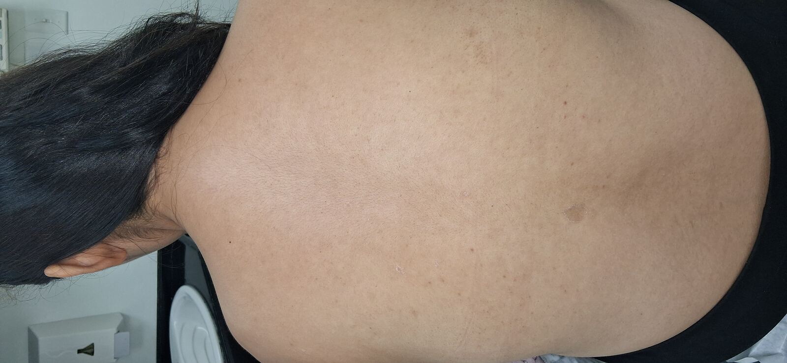 Pitiriasis rosada: imagen después
