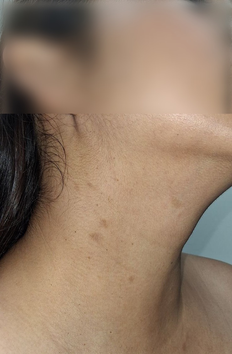 Caso clínico de Pitiriasis rosada