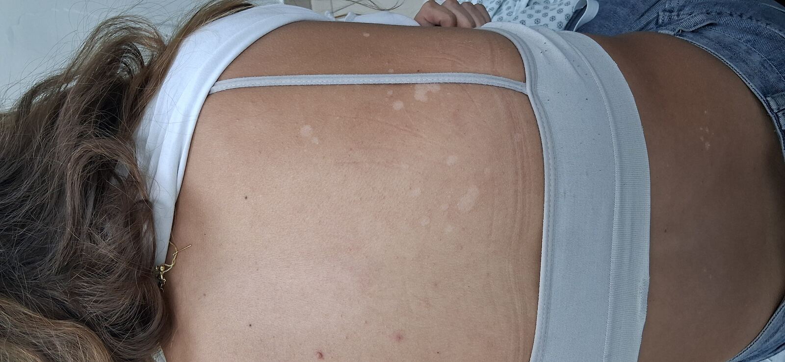 Pitiriasis versicolor e hipomelanosis guttata: imagen después