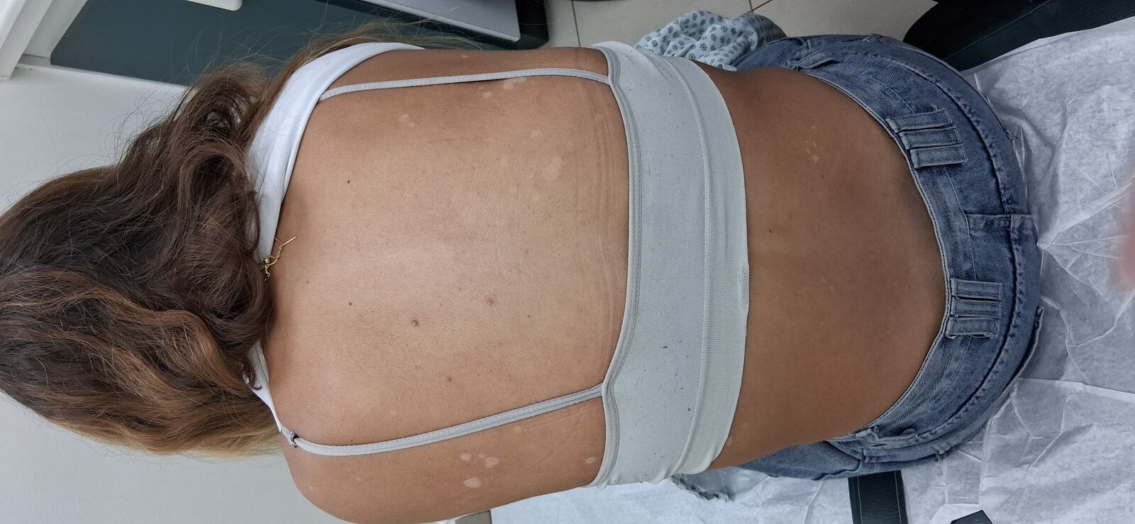 Caso clínico de Pitiriasis versicolor e hipomelanosis guttata