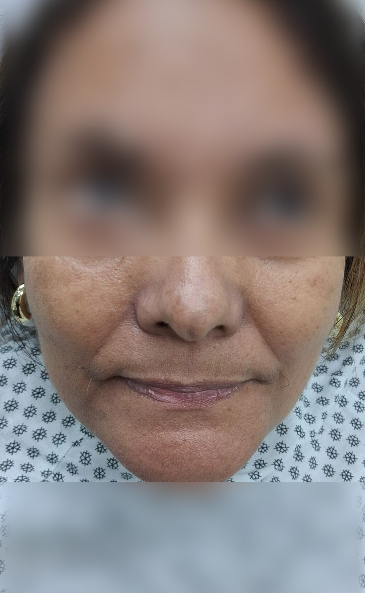 Caso clínico de Post Mohs