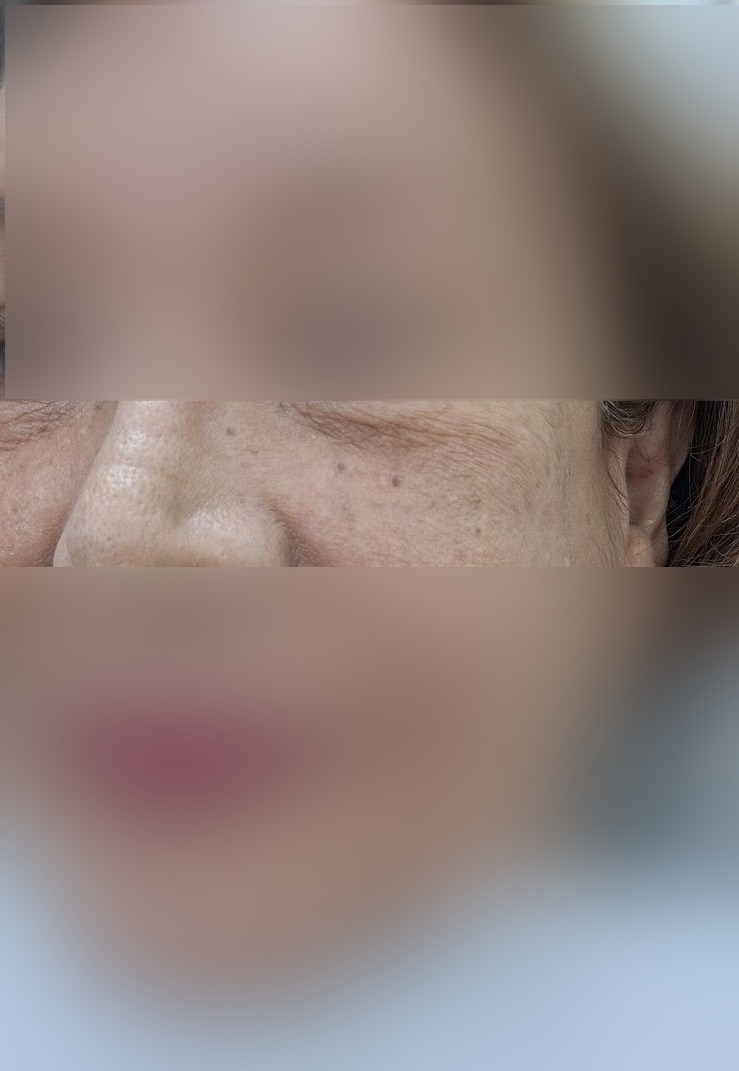Queratosis actínica: imagen antes