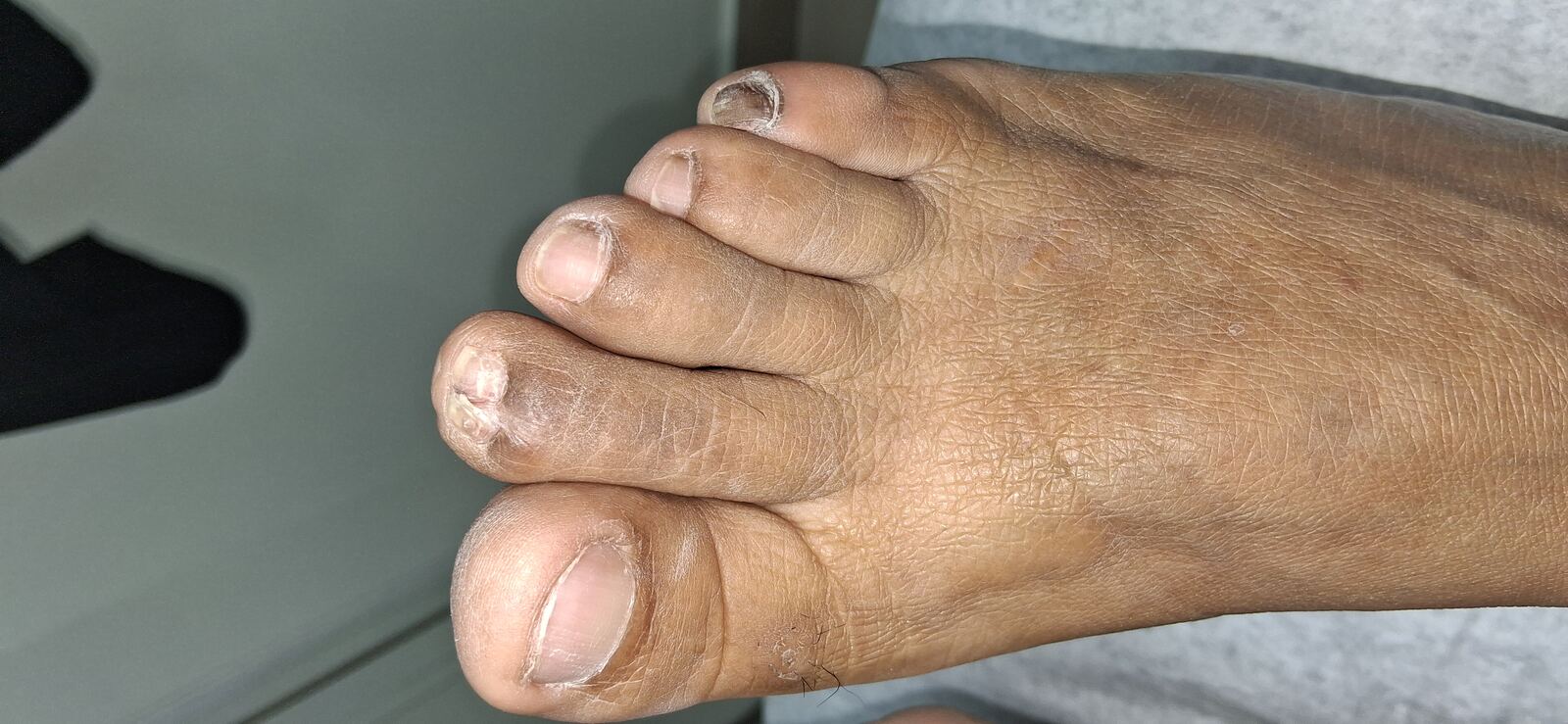 Tumor glómico: imagen antes