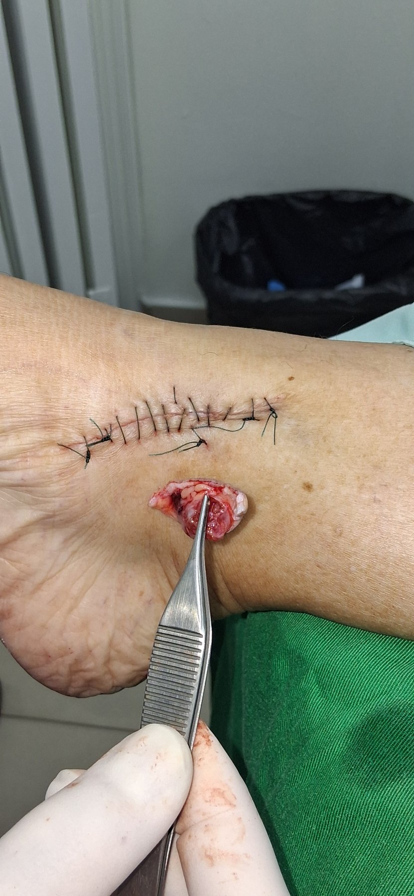 Tumor mixto: imagen antes